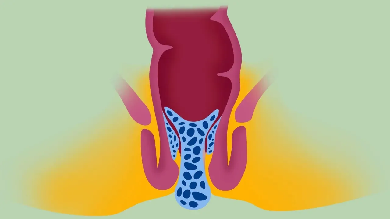 Transanale Offene Hämorrhoidopexie – Videostandbild 1 von 5
