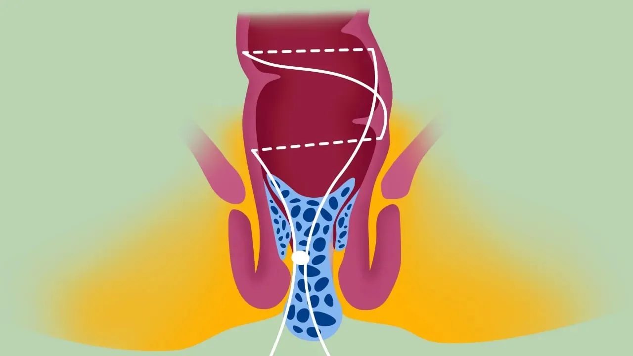 Transanale Offene Hämorrhoidopexie – Videostandbild 3 von 5