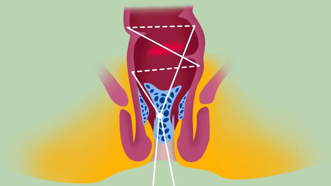 Transanale Offene Hämorrhoidopexie – Videostandbild 5 von 5