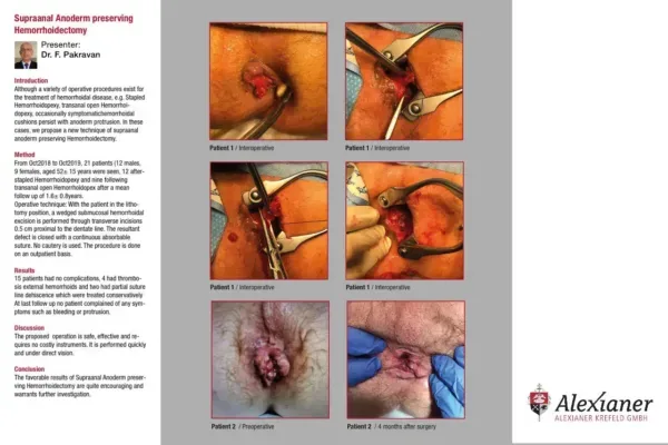 Poster: Supraanal Anoderm Preserving Hemorrhoidectomy, Boston